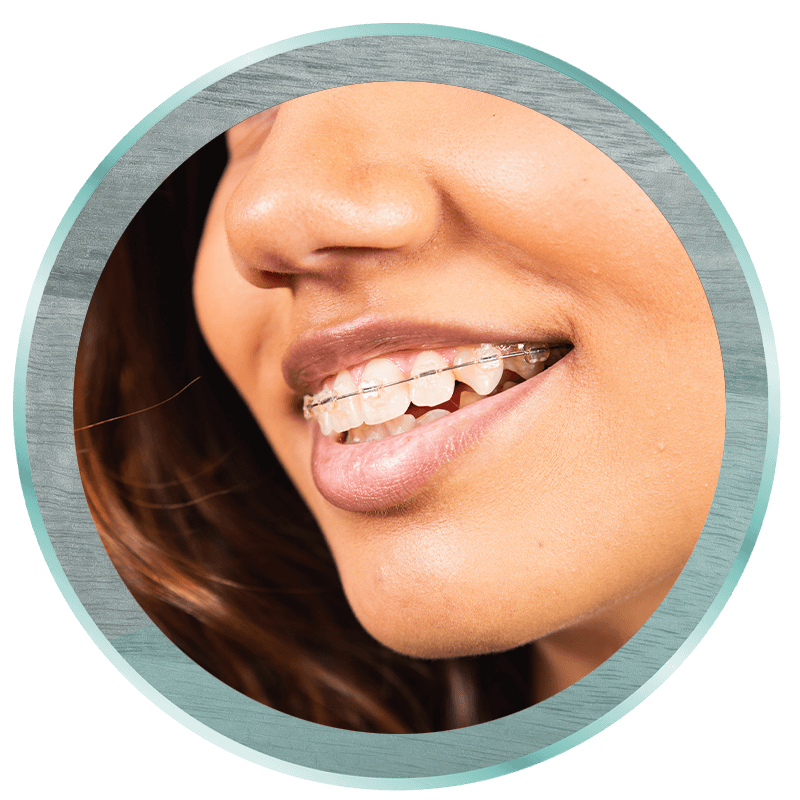 clear braces