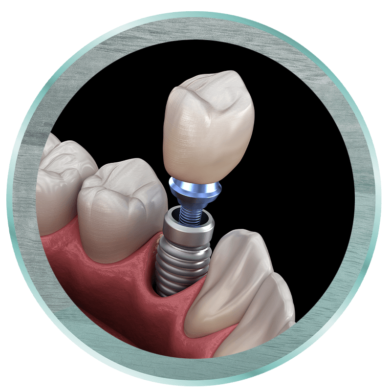 implant