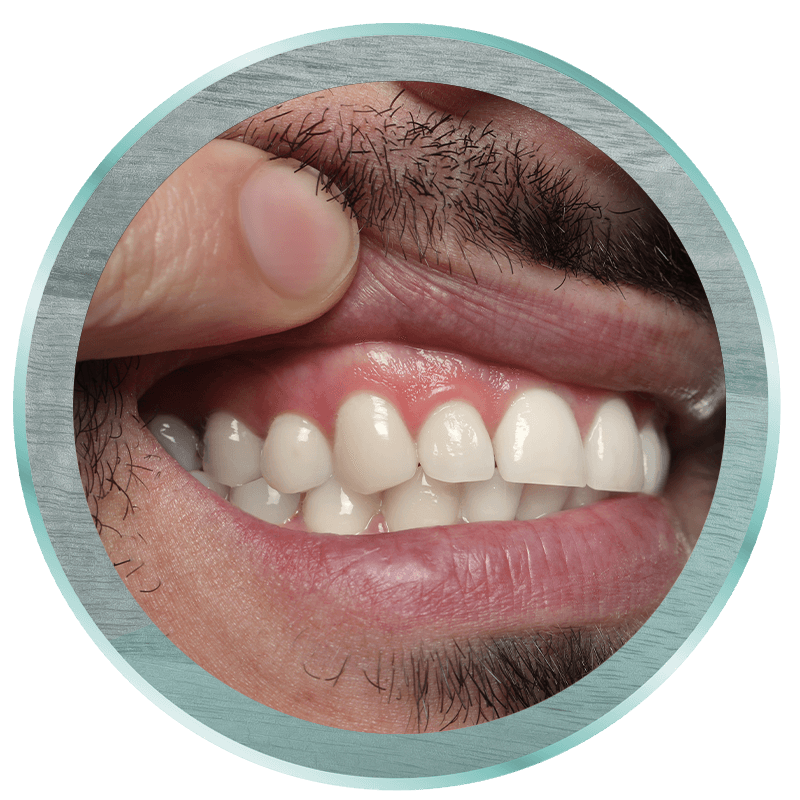 gum